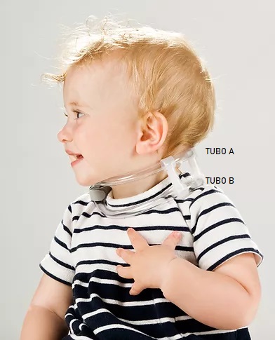 A child with the EOS cervical collar
