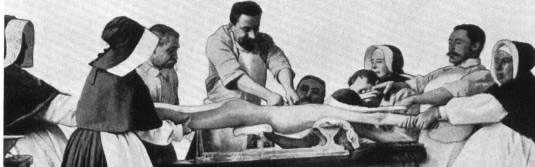 foto antigua donde se ve a un tecnico ortopedico ayudado por colaboradores colocar un corse ortopedico