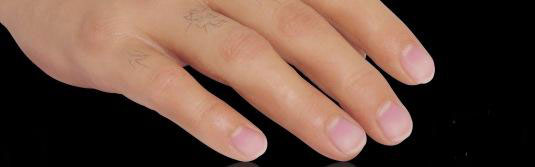 encaje de gel de miembro superior