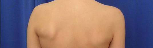 foto de un adolescente con una espalda en la que se puede percibir facilmente una escoliosis