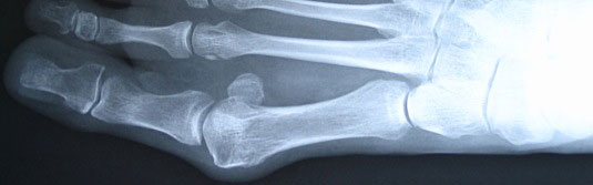 radiografia de un pie con hallux valgus